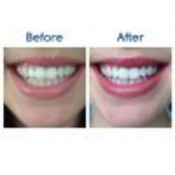 Deluxe Teeth Whitening Kit - Picture 5 of 5